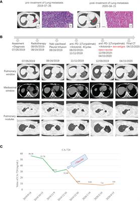 Case Report: Pathological Complete Response in a Lung Metastasis of Phyllodes Tumor Patient Following Treatment Containing Peptide Neoantigen Nano-Vaccine